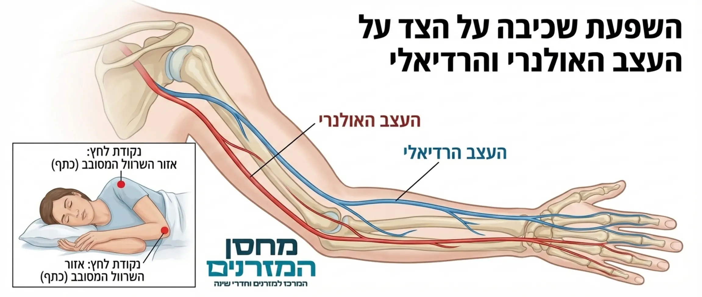 אינפוגרפיקה רפואית המציגה את מערכת העצבים ביד, בדגש על העצב האולנרי והרדיאלי, ומראה היכן נוצר לחץ בזמן שכיבה על הצד